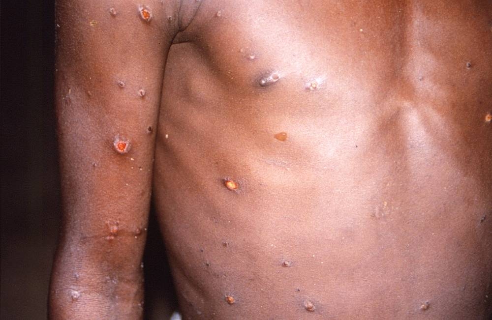 Australia reports first monkeypox case in traveller from Britain