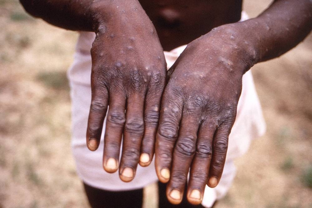 WHO calls emergency meeting as monkeypox cases cross 100 in Europe