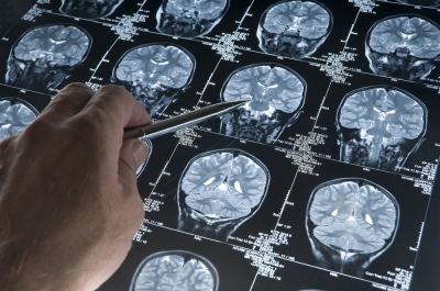 Study: New treatment shows promise against fatal neurological disease ALS