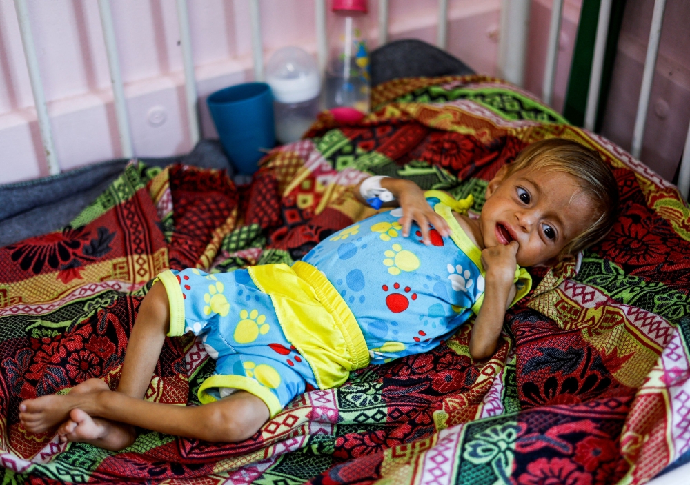 A Palestinian child lays on a bed as patients are treated in the corridors at Nasser hospital, in Khan Younis, in the southern Gaza Strip, July 8, 2024. — Reuters pic  