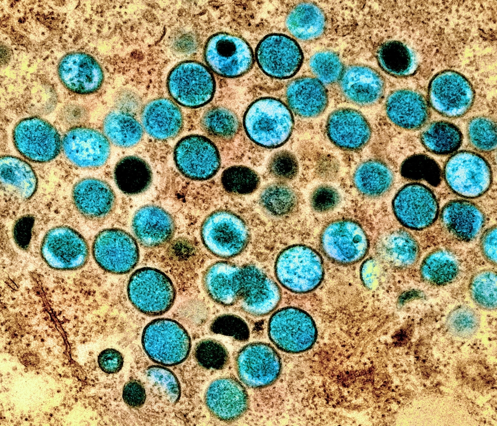 An undated colourised transmission electron micrograph of mpox virus particles (teal) found within an infected cell (brown) cultured in the laboratory, captured at the National Institute of Allergy and Infectious Diseases (NIAID) Integrated Research Facility (IRF) in Fort Detrick, Maryland. — NIAID handout pic via Reuters