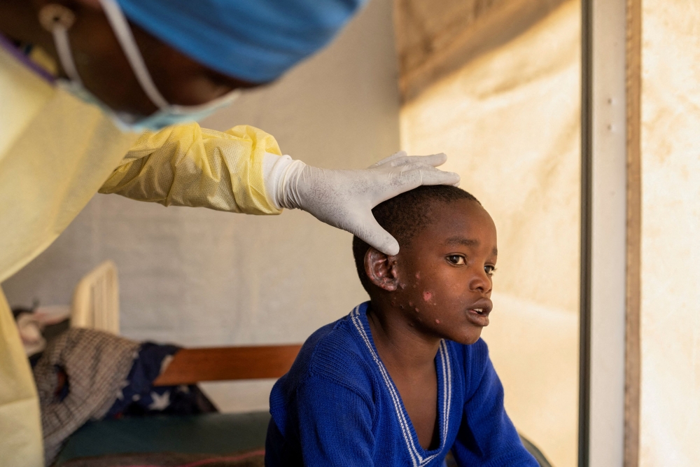 Dr Tresor Wakilongo verifies the evolution of skin lesions on the ear of Innocent, suffering from Mpox — an infectious disease caused by the monkeypox virus that sparks off a painful rash, enlarged lymph nodes and fever; at the treatment centre in Munigi, following Mpox cases in Nyiragongo territory near Goma, North Kivu province, Democratic Republic of Congo July 19, 2024. — Reuters pic