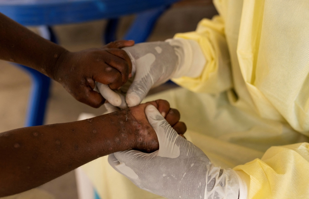 Christian Musema, a laboratory nurse, takes a sample from a child declared a suspected case of Mpox  at the treatment centre in Munigi, following Mpox cases in Nyiragongo territory near Goma, North Kivu province, Democratic Republic of the Congo July 19, 2024. — Reuters pic  