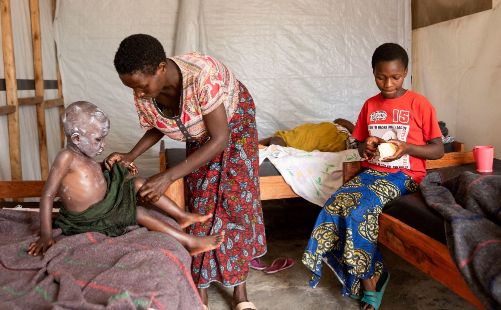 A woman applies medicine to the skin of her child, who is undergoing treatment for Mpox, an infectious disease caused by the Mpox virus that causes a painful rash, enlarged lymph nodes and fever, in Munigi, Nyiragongo territory, near Goma in North Kivu province of the Democratic Republic of Congo August 19, 2024. — Reuters pic  