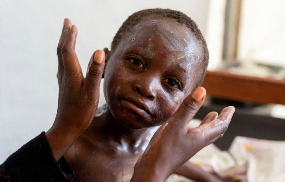 Elisabeth Furaha applies medication on the skin of her child Sagesse Hakizimana who is under treatment for Mpox, an infectious disease caused by the Mpox virus that causes a painful rash, enlarged lymph nodes and fever, at a health centre in Munigi, Nyiragongo territory, near Goma in North Kivu province of the Democratic Republic of Congo August 19, 2024. — Reuters pic  