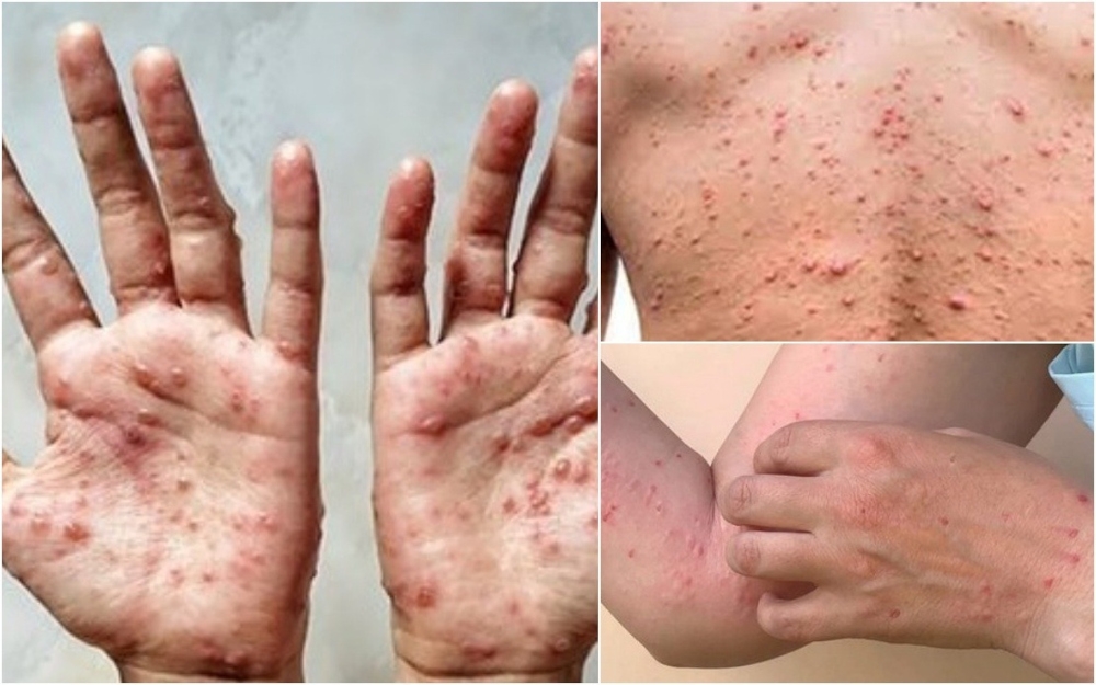 Health Minister Datuk Seri Dr Dzulkefly Ahmad said until now, mpox cases in Malaysia remain at nine cases recorded at the end of last year. — Bernama pic