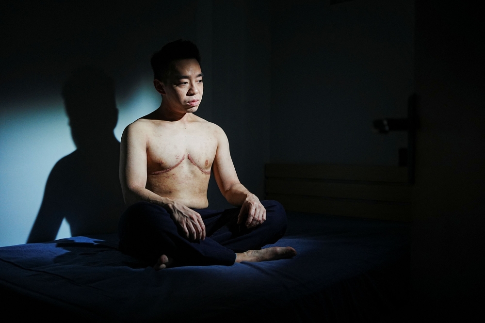 The scars of transgender singer-songwriter Xavian Wu after the surgery are pictured in Hong Kong, China August 12, 2024. — Reuters pic