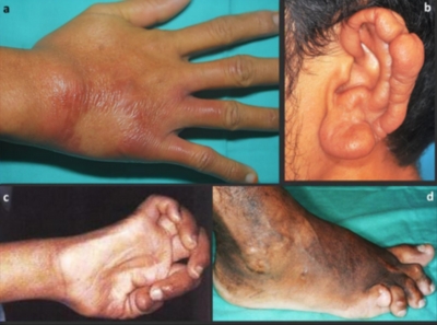 MoH: Leprosy cases in Kuala Pilah under control, early detection efforts ongoing